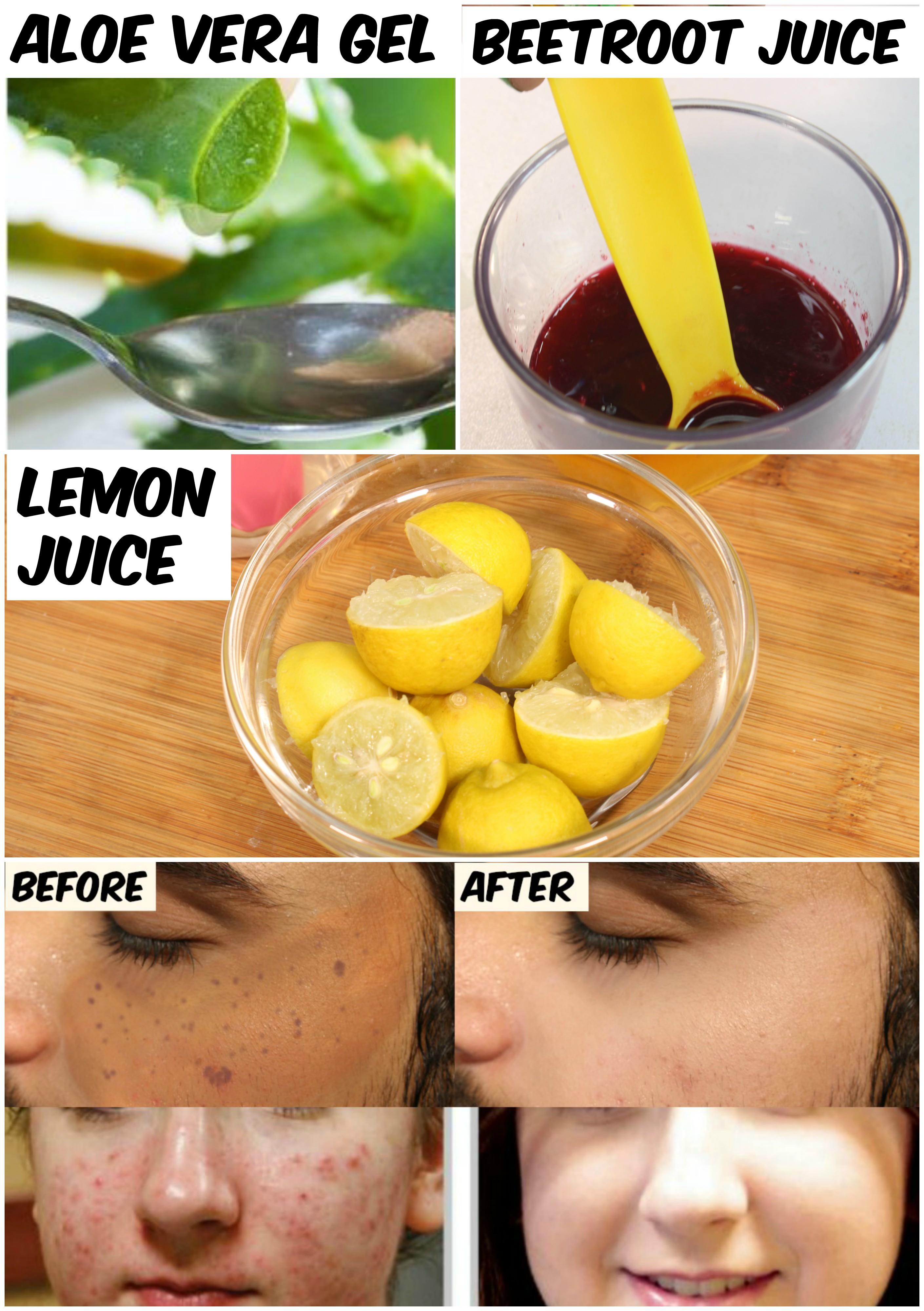 how to get rid of acne