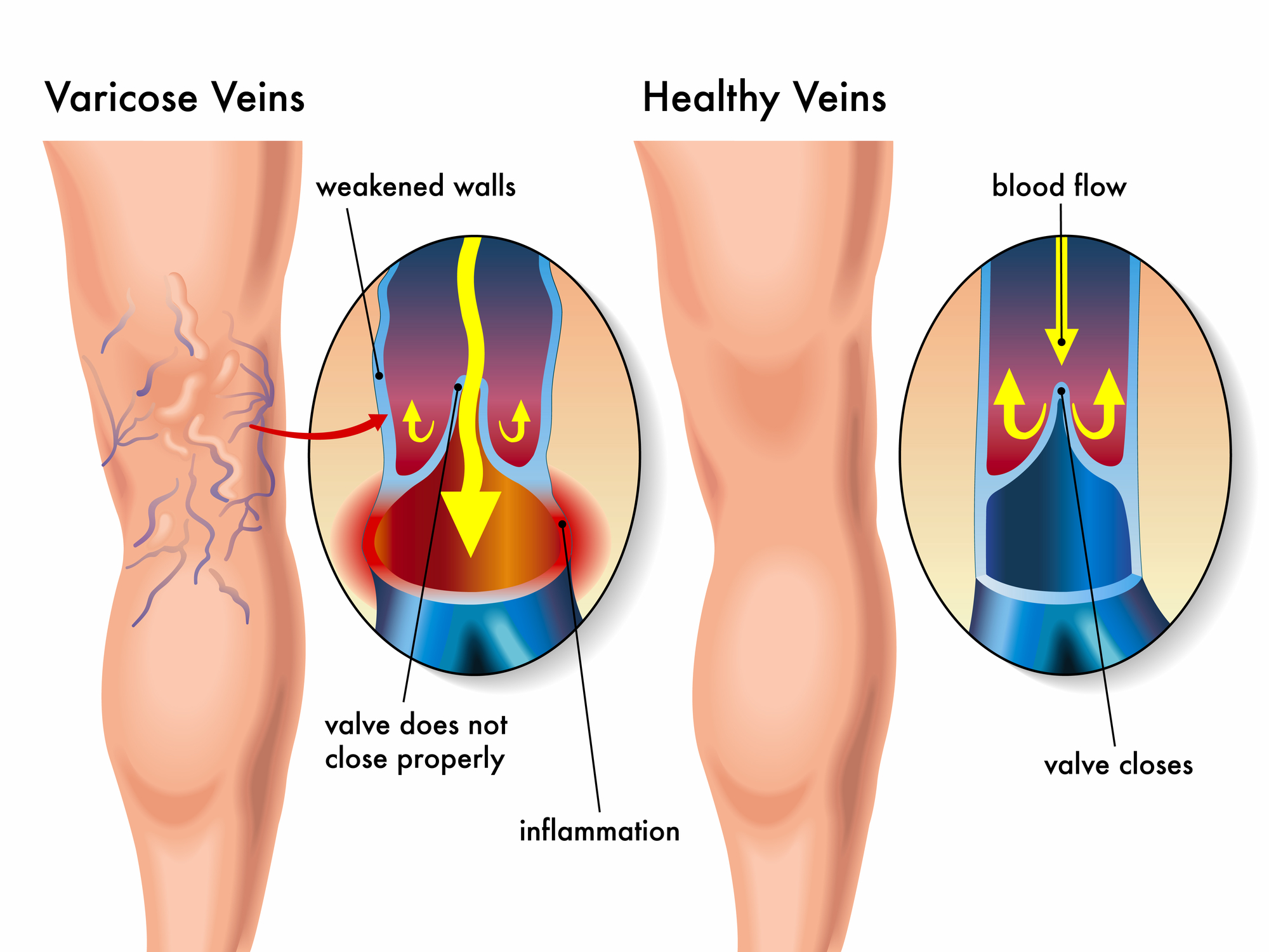 varicose veins