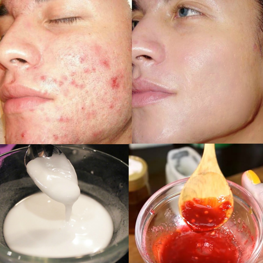 home remedy for acne and pimples