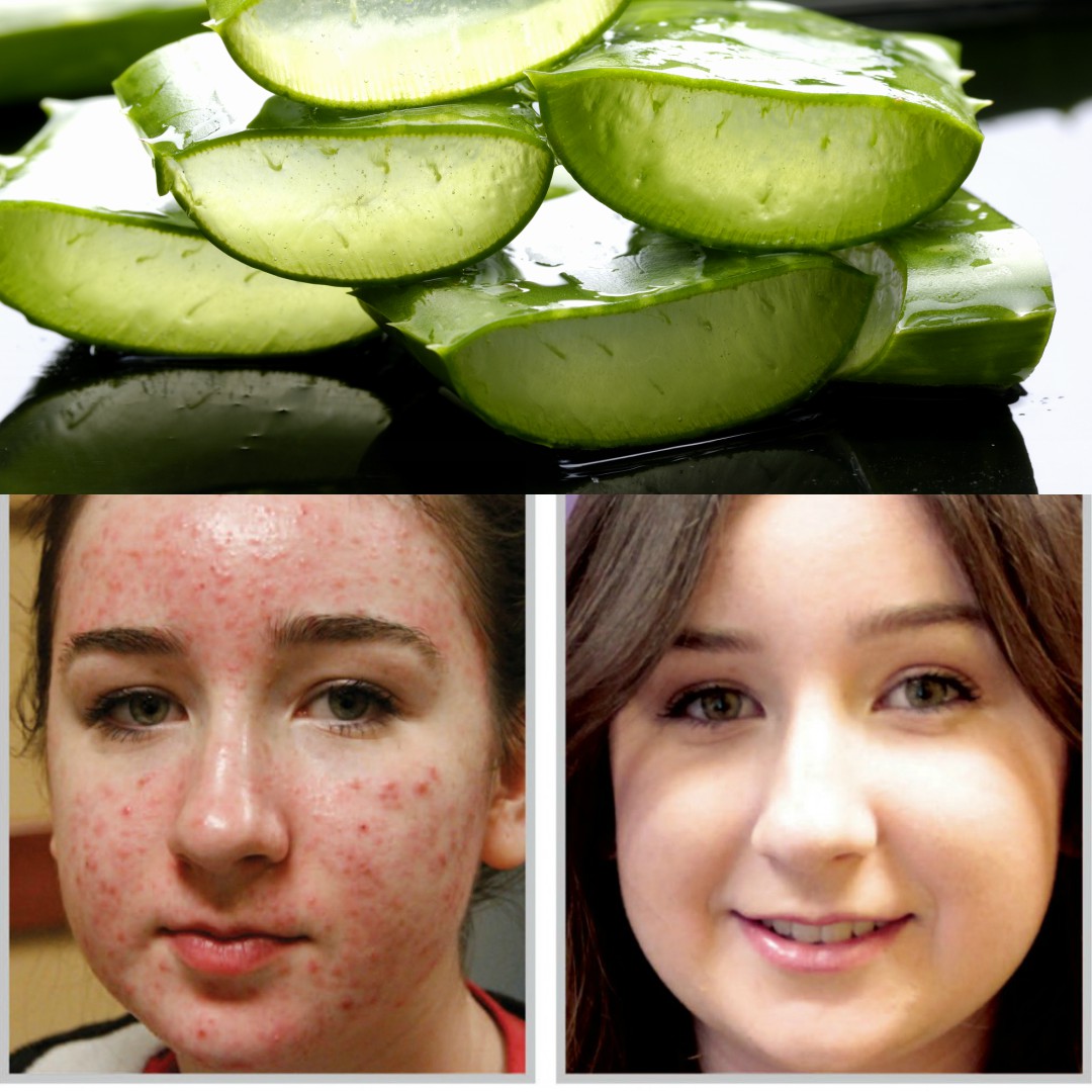 home remedy for acne and pimples