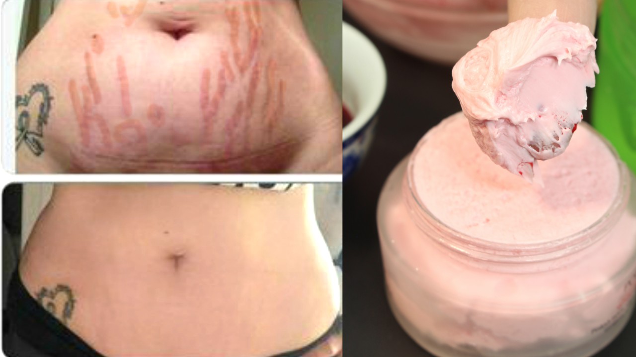 Stretch Marks Removal