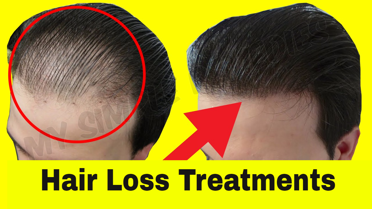 Top 5 Natural Hair Loss Treatment For Men My Simple Remedies