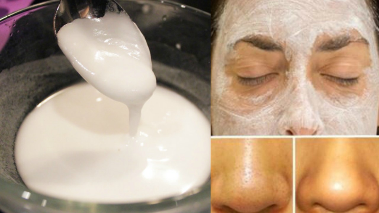 how to remove blackheads and whiteheads