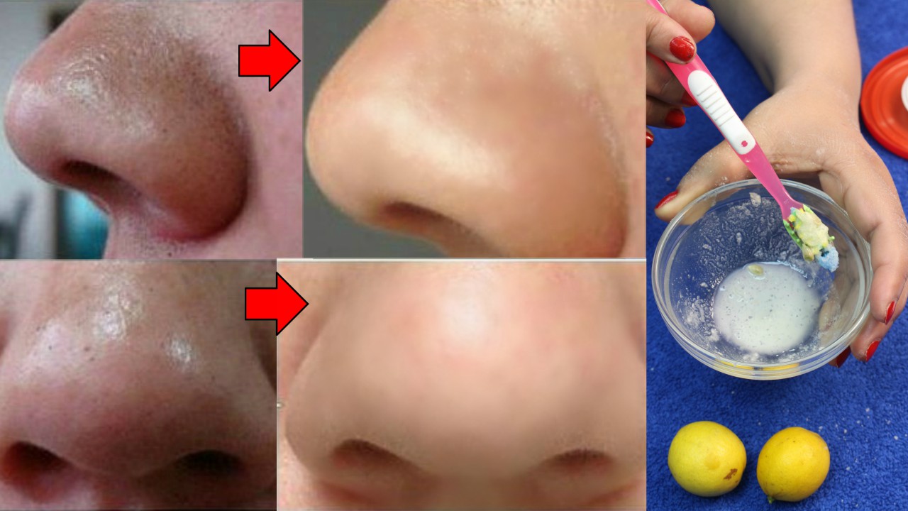 how to remove blackheads and whiteheads