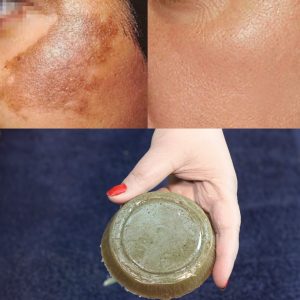 dark spots on face