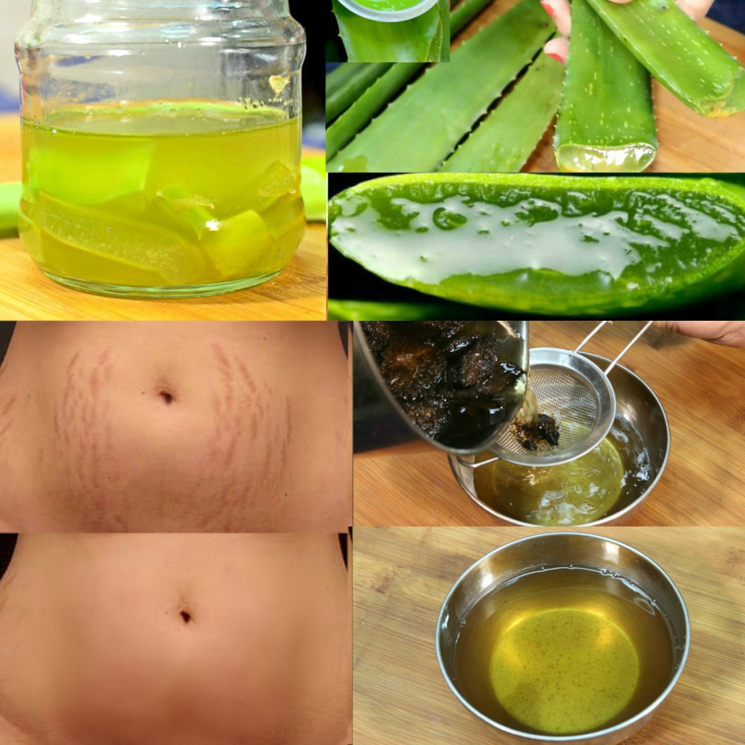 aloe vera for stretch marks