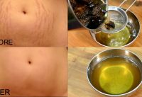 homemade oil for stretch marks