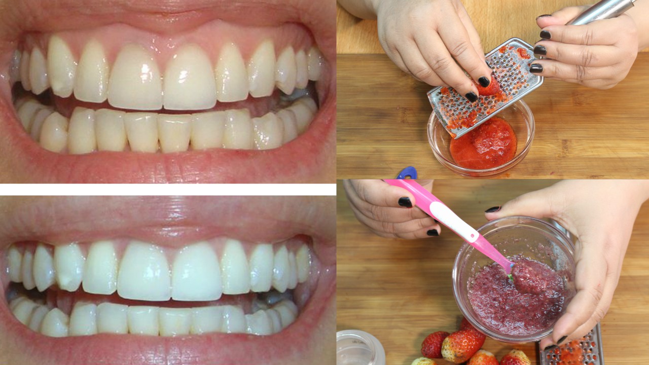 How To Whiten Your Teeth Naturally At Home Quickly & Instantly
