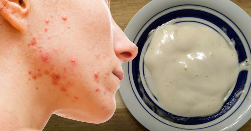 home remedies for acne and pimples