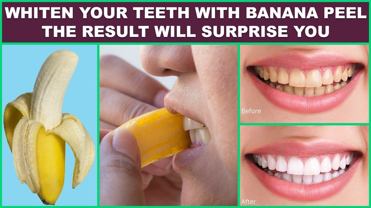 banana peel for teeth