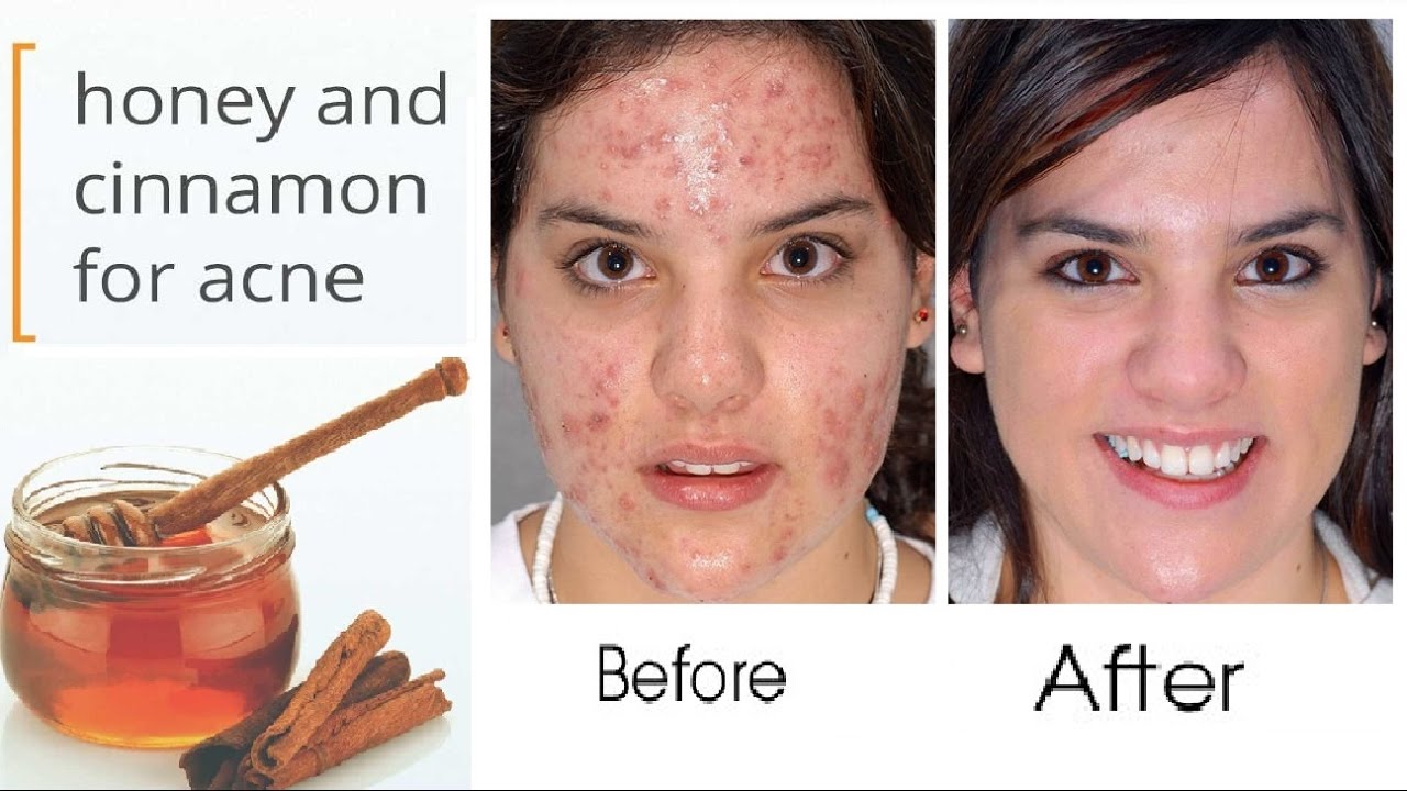 home remedies for acne and pimples