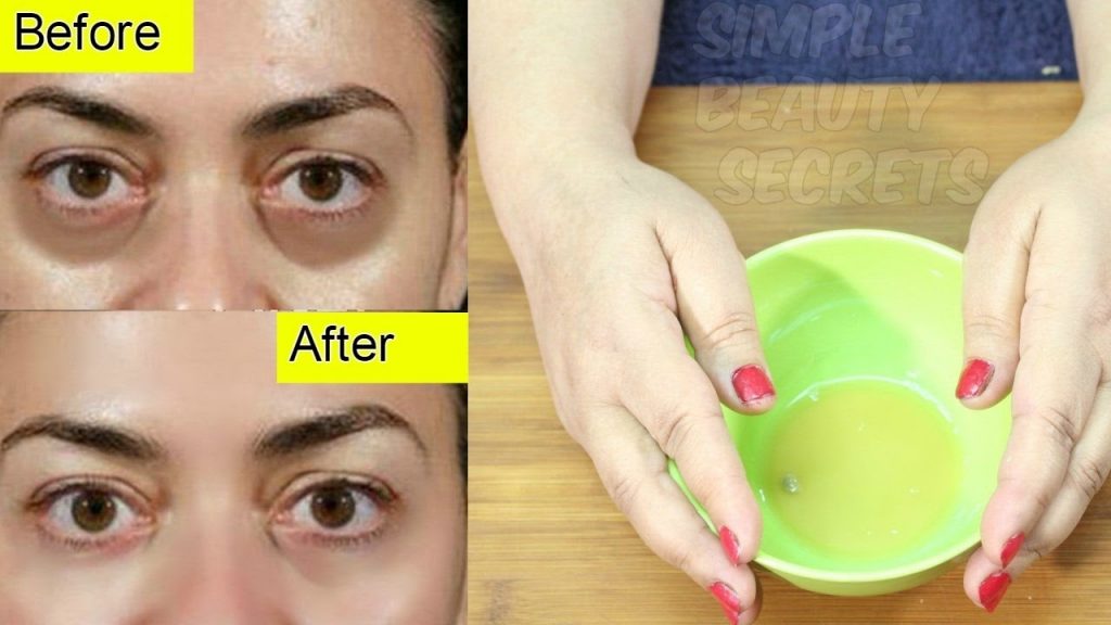 How To Get Rid Of Dark Circles Naturally – Easy & Effective – My Simple ...