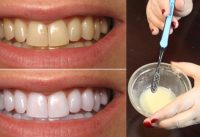 how to whiten your teeth