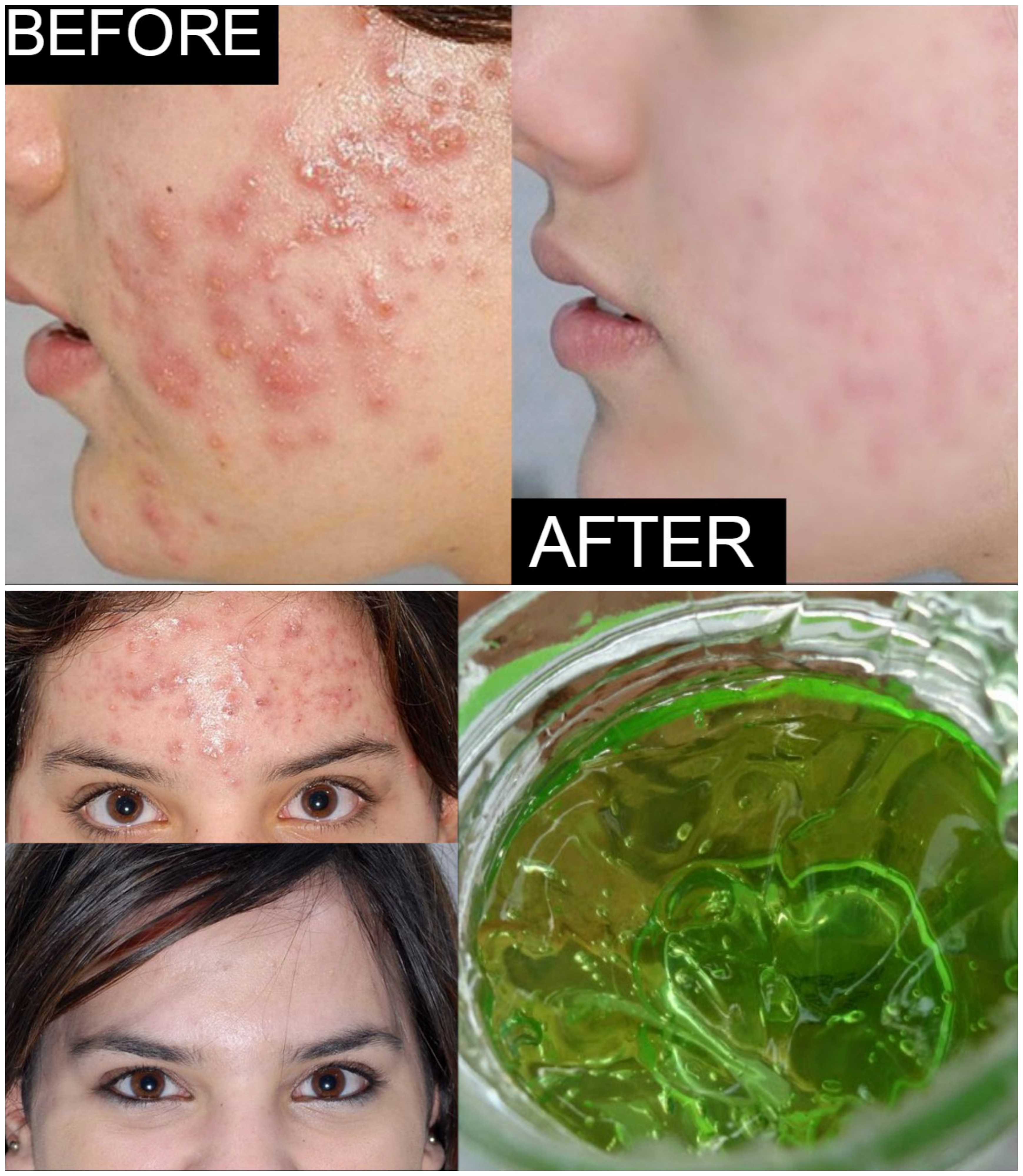 Home Remedy For Acne And Pimples - How To Get Rid of Acne