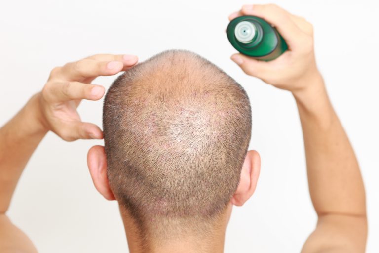 Top 5 Natural Hair Loss Treatment for Men – My Simple Remedies